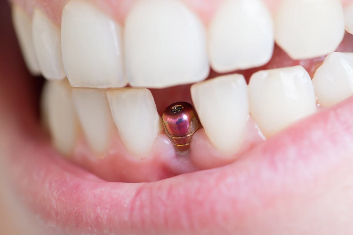 The Ultimate Guide to Getting the Best Dental Implants